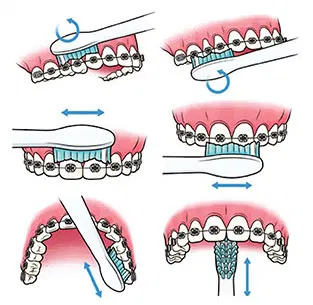 brushing with braces